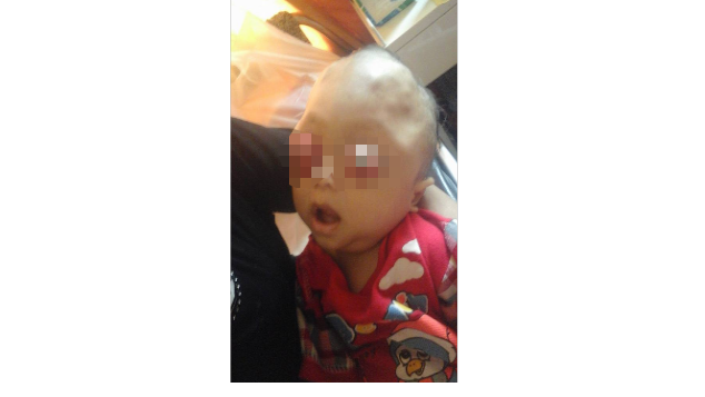 Bayi Asal Lampung Terserang Tumor Mata