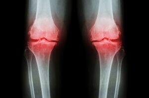 Metode Terkini Atasi Nyeri Sendi