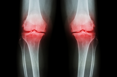 Metode Terkini Atasi Nyeri Sendi