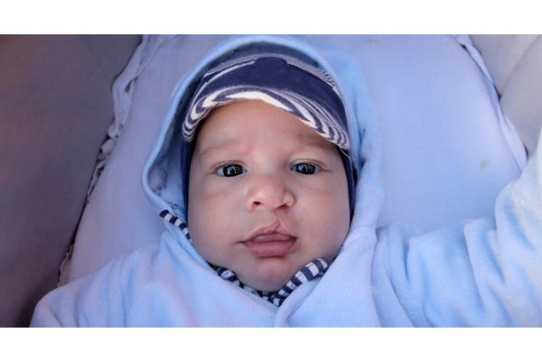 5 Penyebab Bibir Sumbing pada Bayi, Cegah Risikonya!