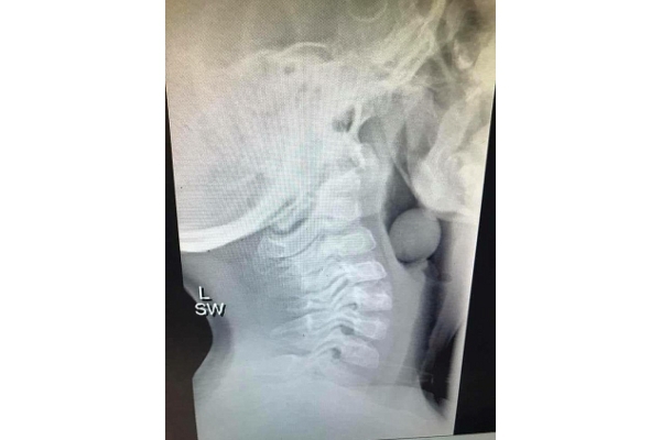 Waspada! Buah Anggur Berisiko Bikin Anak Tersedak