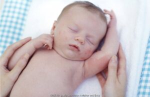 Cara Tepat Mengatasi Biang Keringat Bayi dan Balita