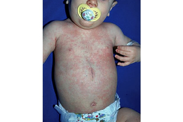 Kenali Penyebab, Gejala dan Pengobatan Roseola