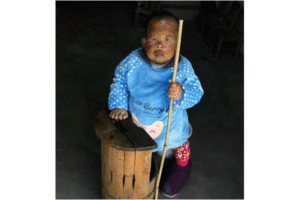 Pria Ini Tampak Seperti Balita karena Penyakit Aneh