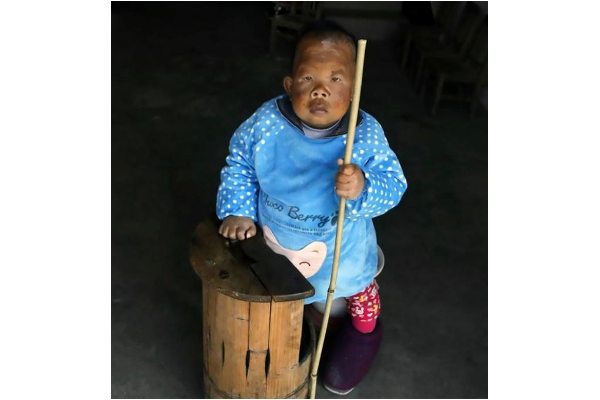 Pria Ini Tampak Seperti Balita karena Penyakit Aneh