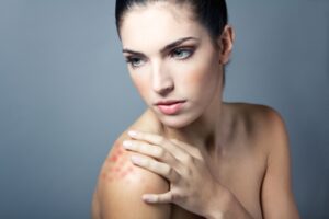 Bercak Merah Bersisik itu adalah Psoriasis