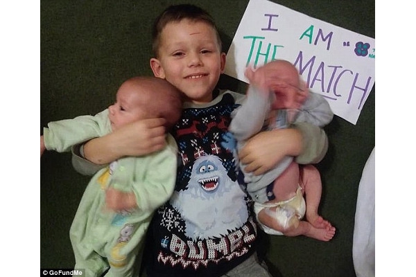 Balita Ini Donorkan Tulang Sumsum untuk Adik Kembarnya