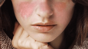 Wanita Lebih Rentan Penyakit Lupus Ketimbang Pria, Lho!