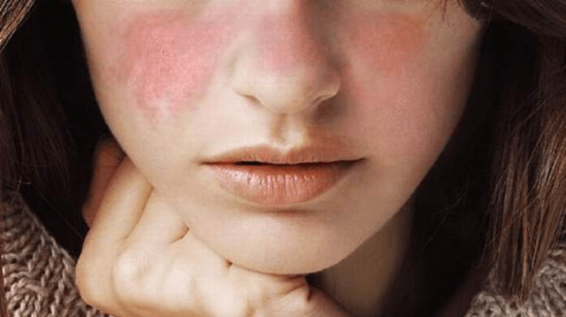 Wanita Lebih Rentan Penyakit Lupus Ketimbang Pria, Lho!