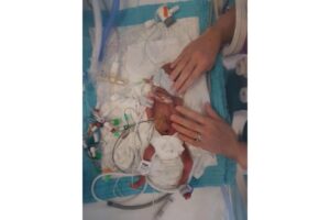 Bayi Yang Lahir Seberat Kaleng Kacang Ini Tumbuh Sehat