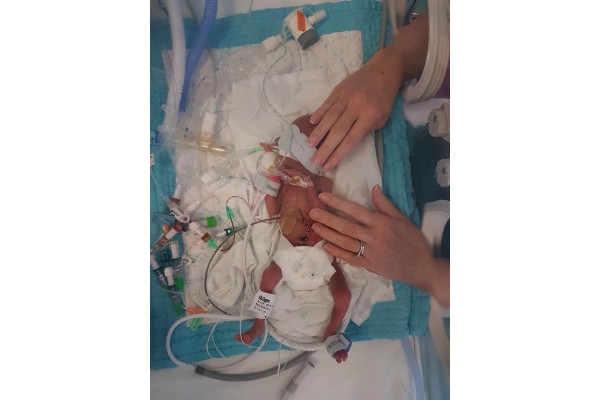 Bayi Yang Lahir Seberat Kaleng Kacang Ini Tumbuh Sehat