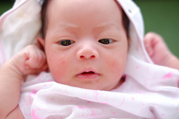 Kenali Tanda Biang Keringat pada Si Kecil