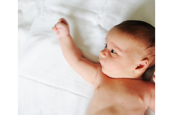 Waspada Bayi Terkena Roseola