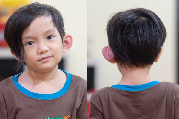 Anak Musisi Anji, Saga, Terkena Sinus Preauricular