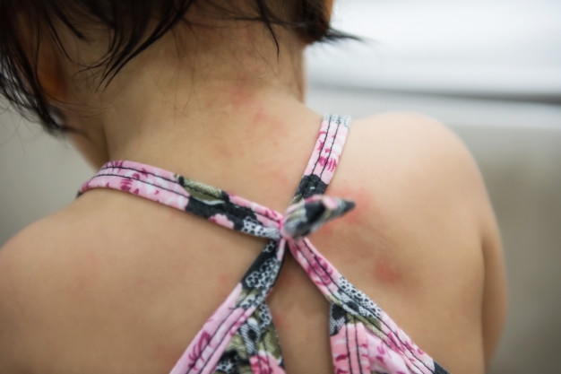 Kenali Penyebab dan Pencegahan Cacar Air pada Anak