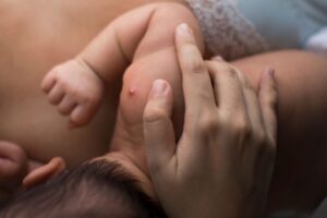 Kenali Penyebab dan Cara Atasi Bisulan pada Anak