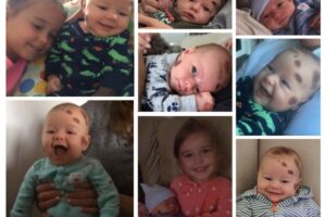 Banyak Tahi Lalat di Tubuh Bayi, Bahayakah?