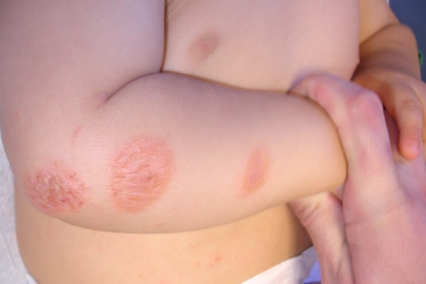 Penyakit Ringworm pada Bayi dan Cara Mengatasinya