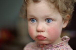 Mengenal Sindrom Pipi Merah pada Anak, Apa Itu?