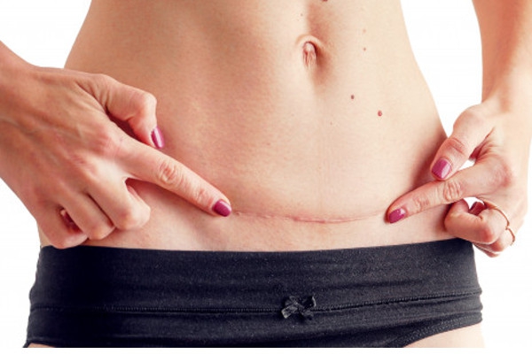 5 Fakta Penting seputar Keloid Pasca Operasi Caesar