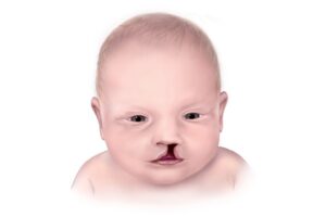 Penyebab Bibir Sumbing pada Anak, bisa Karena Makeup!