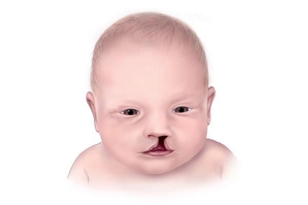 Penyebab Bibir Sumbing pada Anak, bisa Karena Makeup!