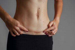 Memulihkan Bekas Luka Caesar