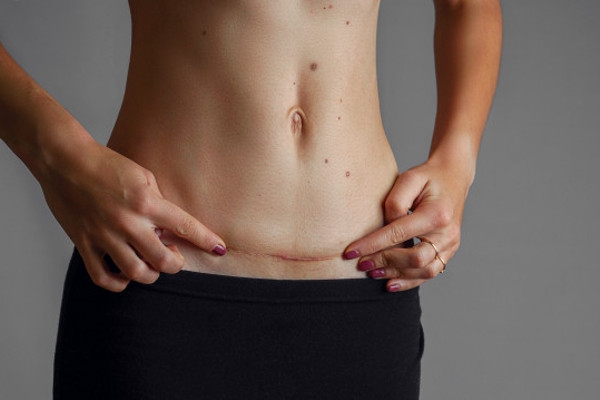 Memulihkan Bekas Luka Caesar