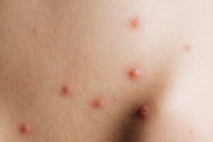 Hati-Hati! Orang Dewasa Juga Bisa Kena Cacar Air, Lho