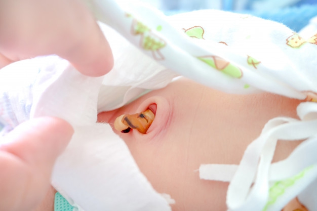 Granuloma Umbilical, Masalah Kesehatan pada Pusar Bayi