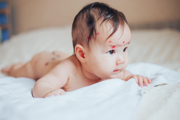 Waspadai 7 Masalah Kulit pada Bayi Baru Lahir