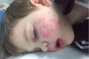 Sering Dicium, Balita Terjangkit Herpes dan Nyaris Buta