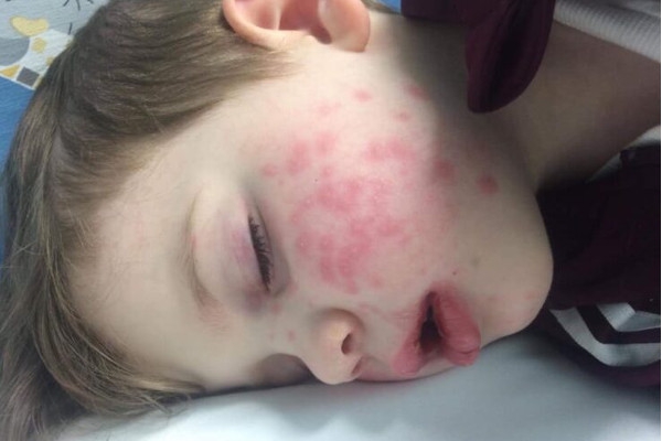 Sering Dicium, Balita Terjangkit Herpes dan Nyaris Buta