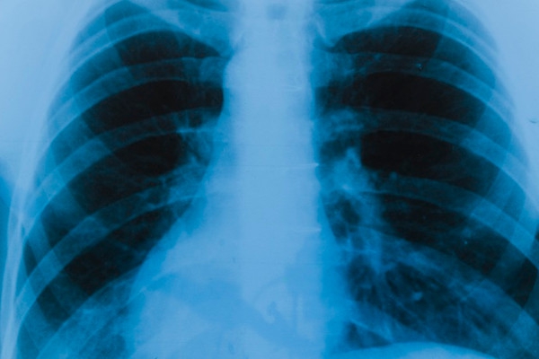 Kasus Langka! KB Implan Berpindah ke Paru-Paru