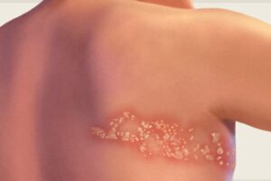 Mengenal Cacar Ular, Lebih Berbahaya Daripada Cacar Air