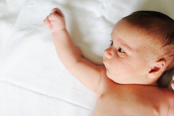 Jika Bayi Mengalami Masalah Kulit dan Muncul Koreng