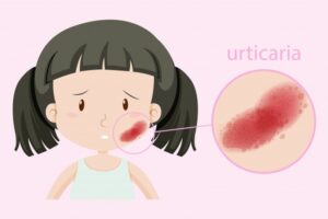 Biduran pada Bayi, Ini Penyebab dan Cara Mengatasinya