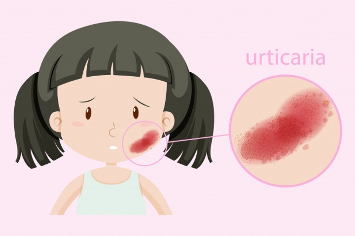 Biduran pada Bayi, Ini Penyebab dan Cara Mengatasinya