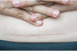 Rekomendasi Penghilang Bekas Luka Akibat Caesar