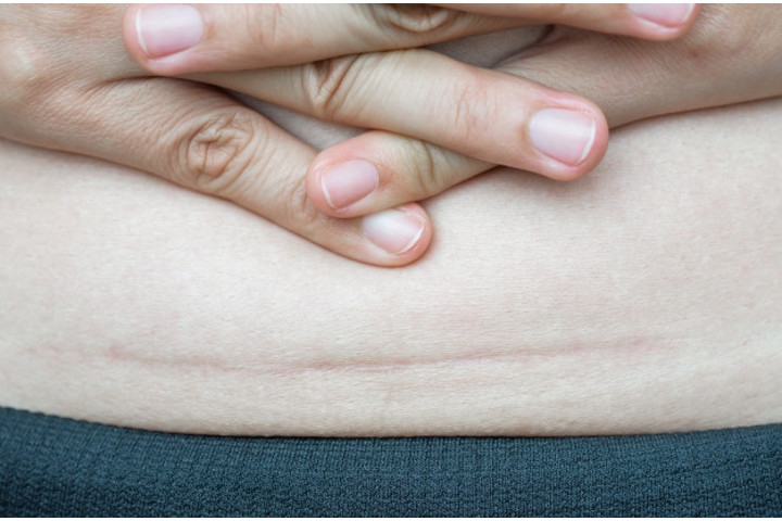 Rekomendasi Penghilang Bekas Luka Akibat Caesar