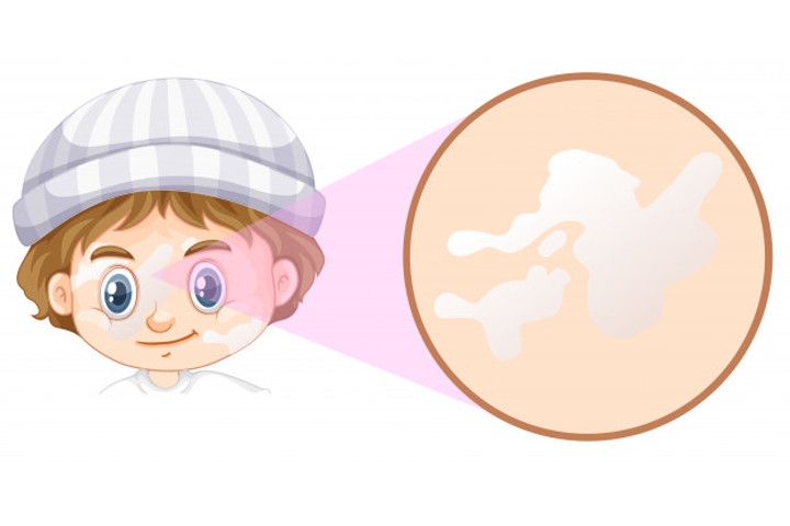 Kenali Serba-Serbi Vitiligo yang Terjadi pada Bayi