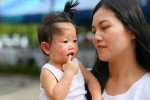 Ini Masalah Kulit yang Sering Dialami oleh Bayi