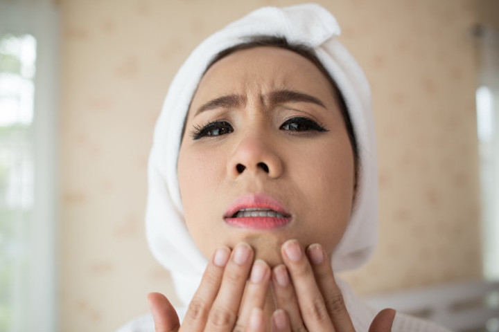 Adult Acne, Jerawat yang Muncul di Usia Dewasa