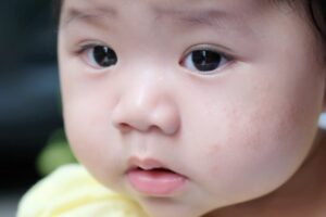 5 Penyebab Kulit Bayi Berjerawat dan Cara Mengatasinya