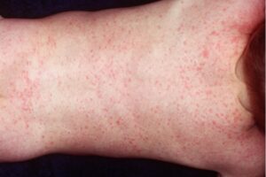 Waspada Roseola Infantum, Kenali Gejala dan Penanganannya