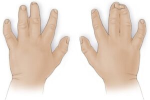 Ketahui Sindaktili, Kelainan Jari Dempet pada Bayi