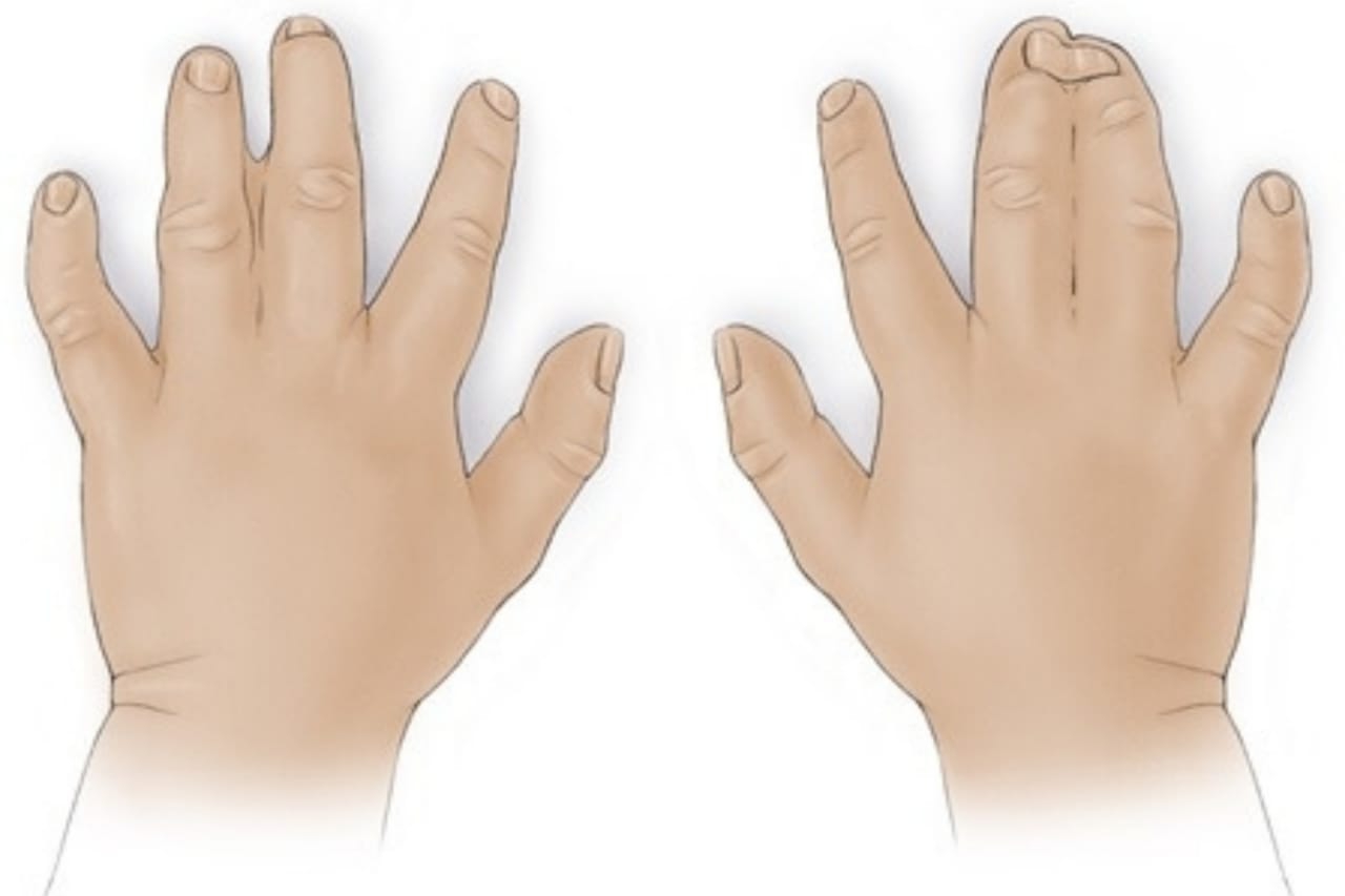 Ketahui Sindaktili, Kelainan Jari Dempet pada Bayi