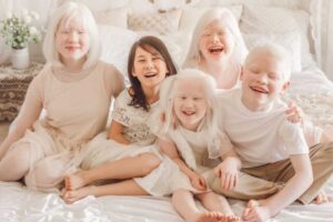 Yang Perlu Anda Ketahui tentang Anak Albino dan Penyebabnya