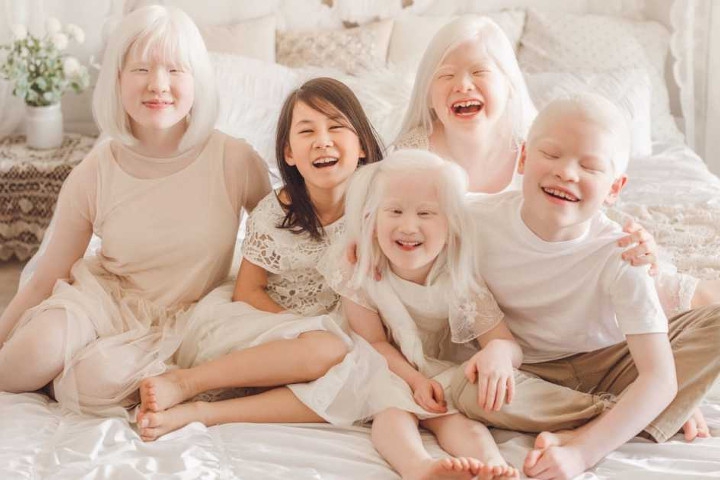 Yang Perlu Anda Ketahui tentang Anak Albino dan Penyebabnya