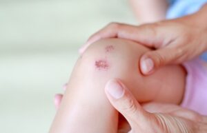 Bahaya Hemofilia pada Anak. Ini Gejala yang Perlu Diwaspadai